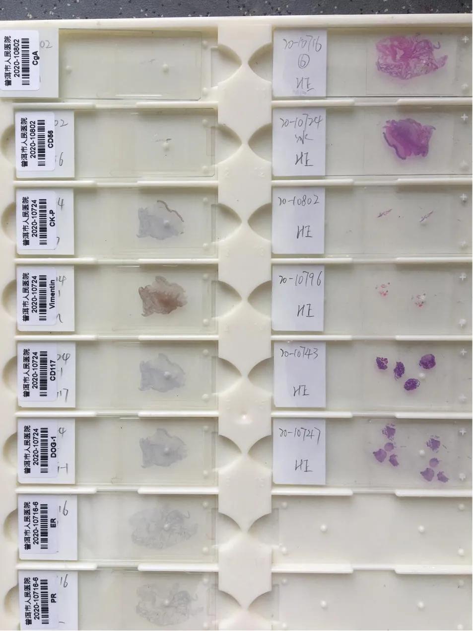 普洱市人民医院有肠镜检查,普洱市人民医院肠镜检查