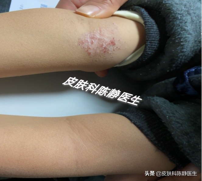 求治宝宝湿疹方法,宝宝湿疹给宝妈支招