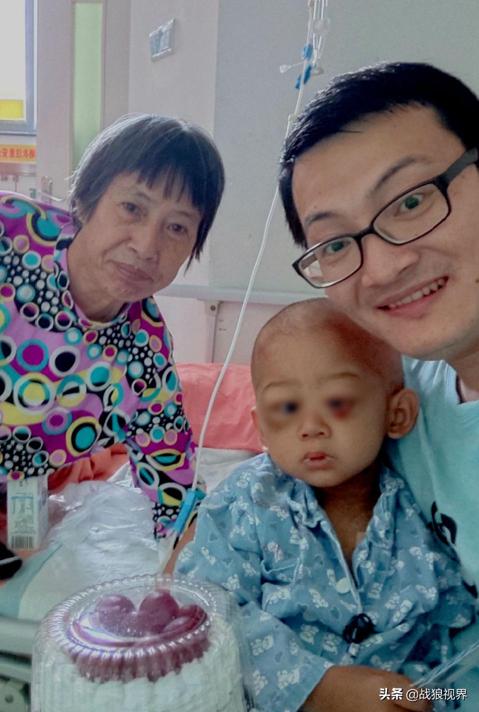 小孩摔一跤后引起眼袋淤青,2岁多男宝眼袋浮肿有点发紫