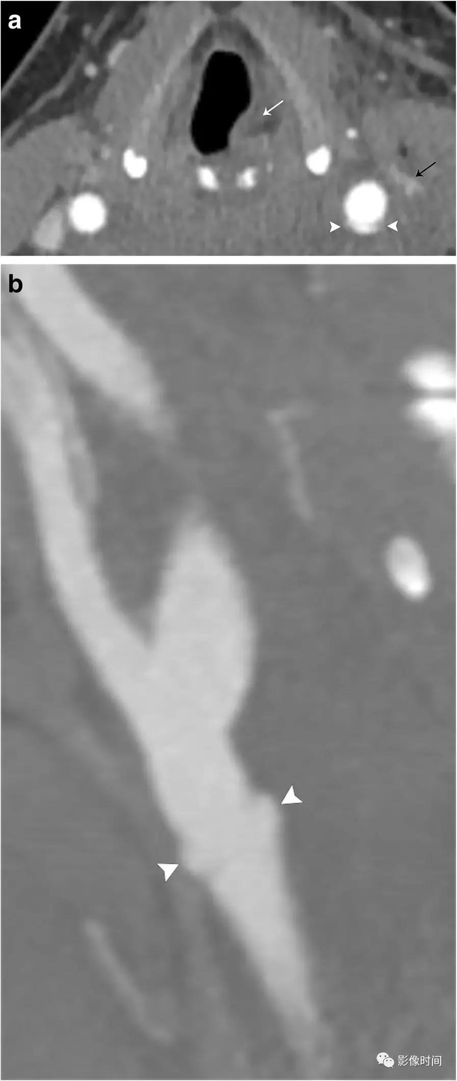 双侧颈动脉鞘间隙多发小淋巴结影,双侧颈动脉间隙多软组织密度结节