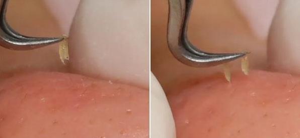 皮肤毛孔变大有脏东西怎么办,脸上毛孔粗大出油能挤出白色颗粒