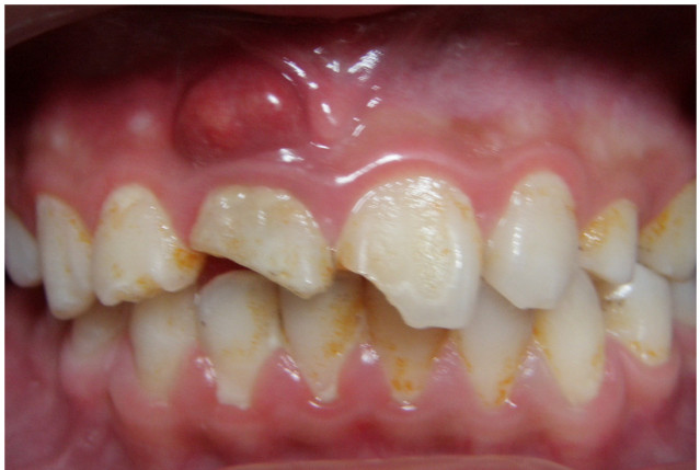 根管治疗可怕,根管治疗很恐怖吗