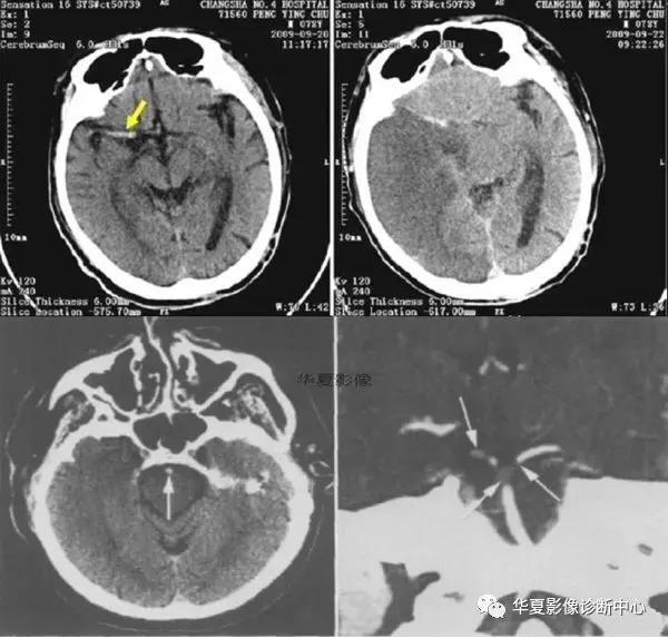 颅脑核磁影像解剖图谱,颅脑mr增强影像图片