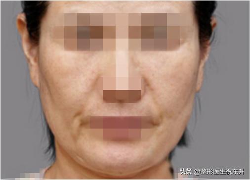 脸部凹陷怎么变饱满面部填充,脸凹陷全脸填充会不好看吗