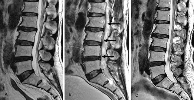哑铃推举常出的错误,哑铃推举做几组就力竭