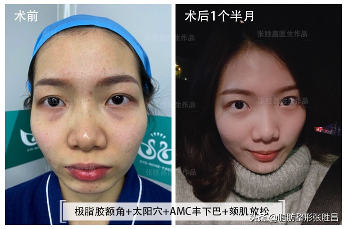 下巴后缩但不想脸变长,下巴后缩不想正颌只想整齐