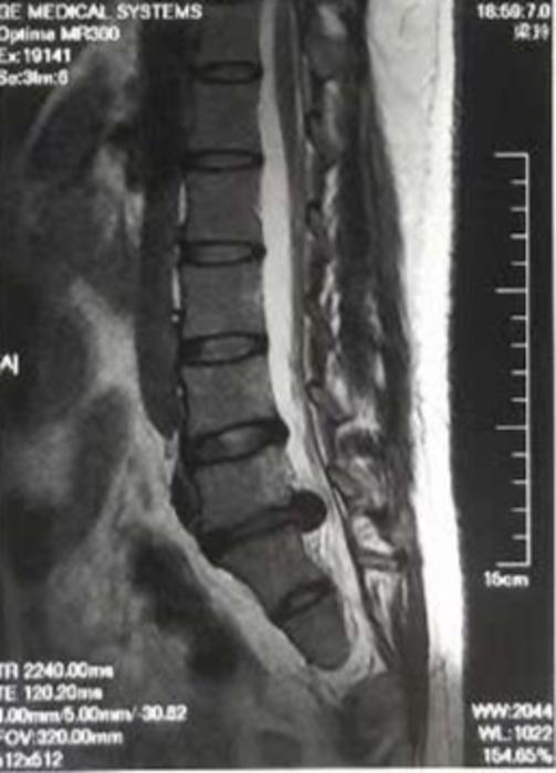 脊柱微创手术好了还能下地干活吗,微创脊柱术后康复锻炼视频