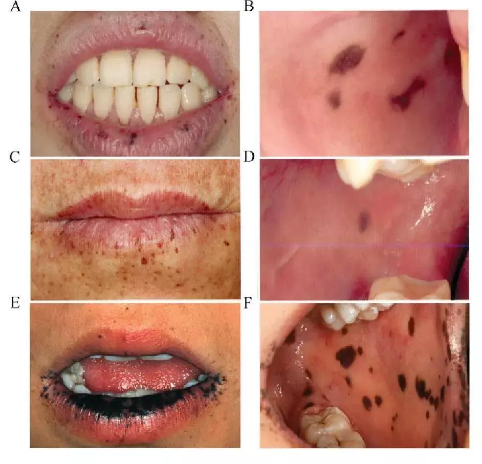 肠内有息肉脸上会长斑吗,有唇斑是肠道息肉吗