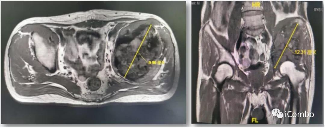 肾癌369例临床分析,恶性肾癌中晚期治疗方案