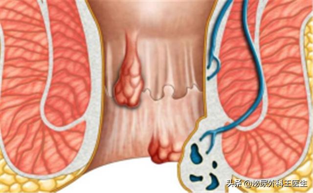 肛门摸到了小肉球，是痔疮还是尖锐湿疣？医生教你从外表就能区分