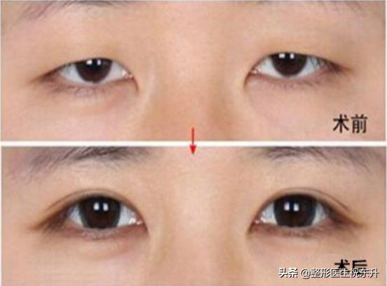 上眼皮松弛预示十种疾病,上眼皮松弛显凶