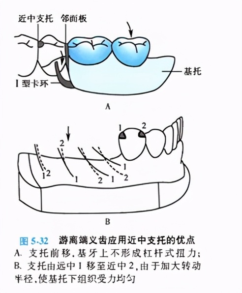 牙列缺损的可摘局部义齿修复题库,牙科美学修复精讲