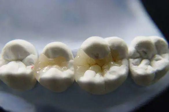 关于牙齿龋坏的小问答,牙齿掉了一半怎么补牙最好