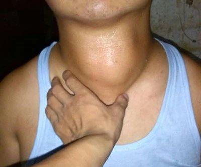 桥本引起甲亢trab抗体会高吗,桥本甲亢的化验单8项