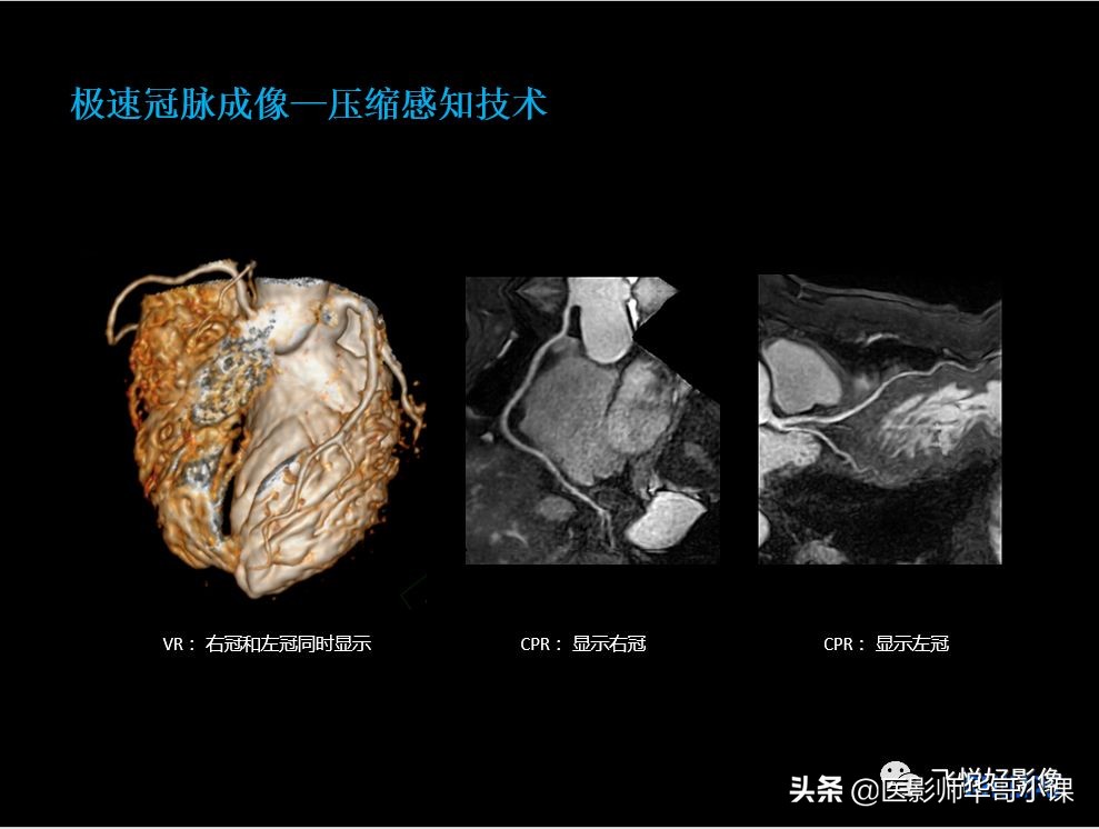 飞利浦核磁共振快速扫描,飞利浦磁共振心脏扫描