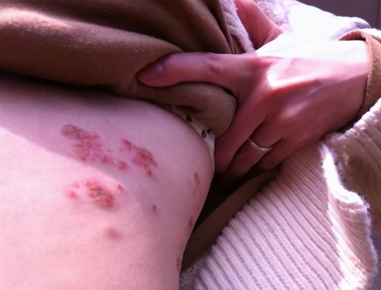 火针治疗淀粉样皮肤病有效吗,引火烧身免费全文