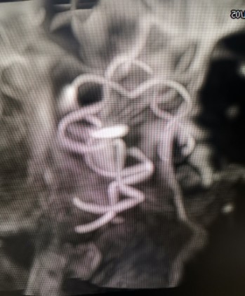 Tubridge®治疗多发性动脉瘤