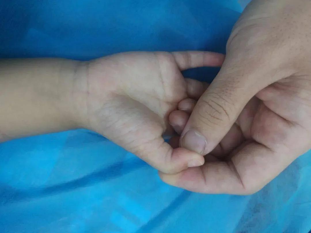 宝宝手指突发腱鞘炎,孩子手指突然伸不直疼