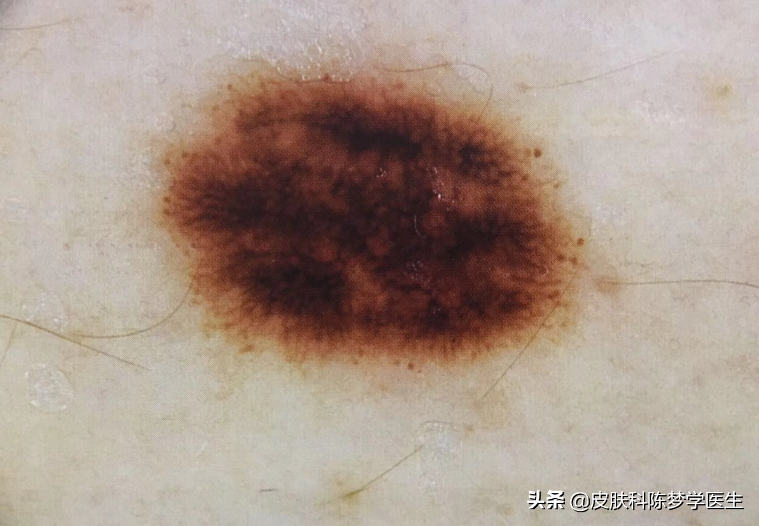 激光点痣为啥痣大了,颠覆你认知的祛斑方式