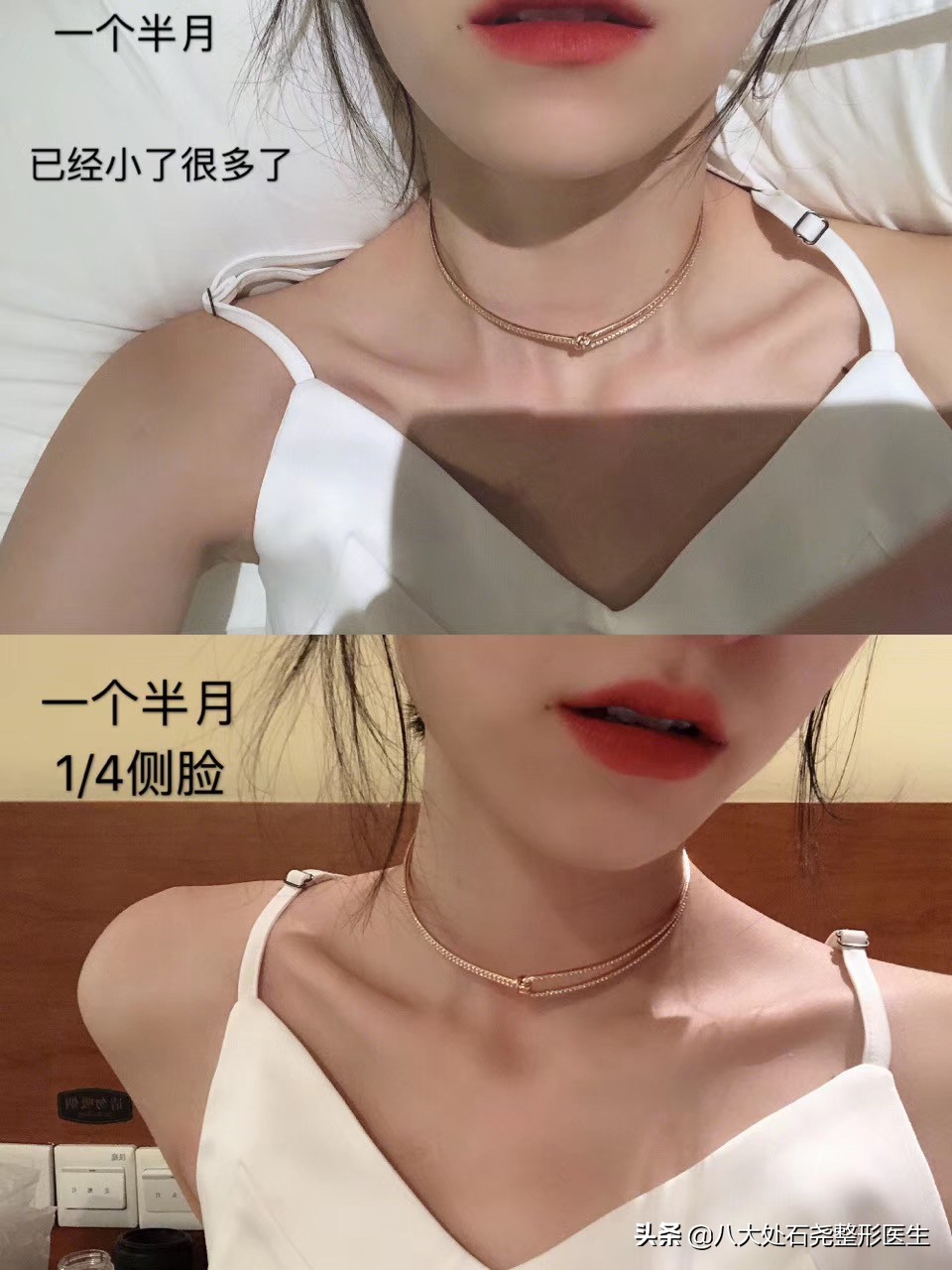 瘦脸针后苹果肌下垂凹陷能恢复吗,你有脸部下垂的烦恼吗