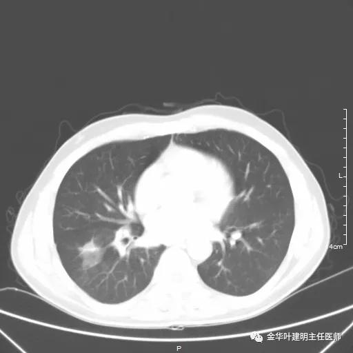 伴有脑转移了的肺癌能手术吗？