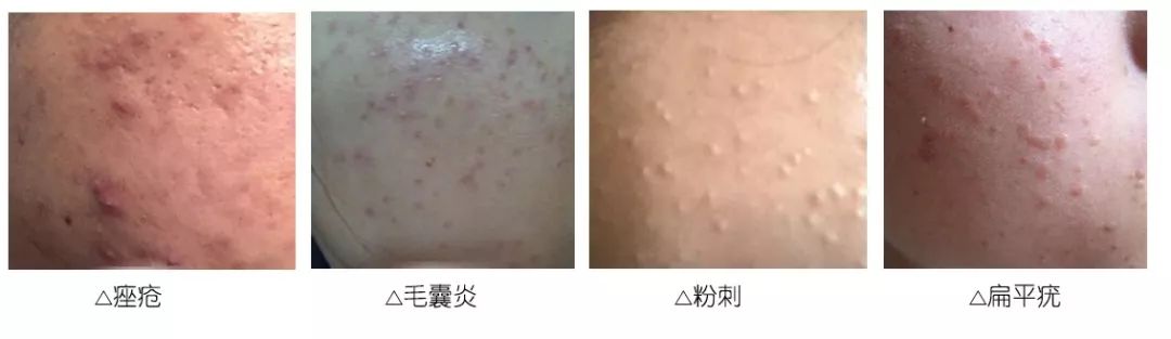 毛囊炎要不要清痘,脸毛囊炎和痘痘的区别
