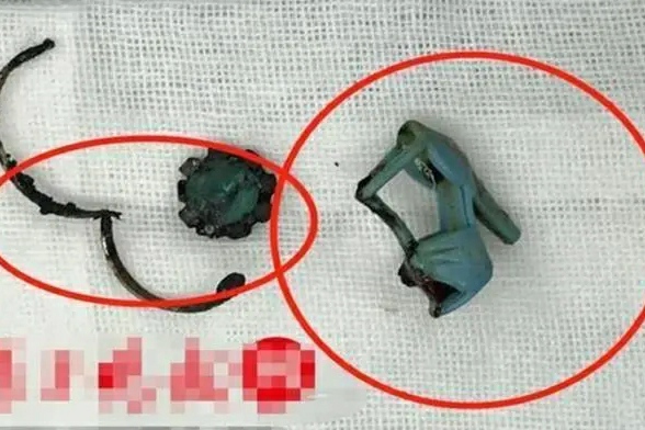 6岁女儿体内发现异物,女孩六岁身体下有异味怎么办