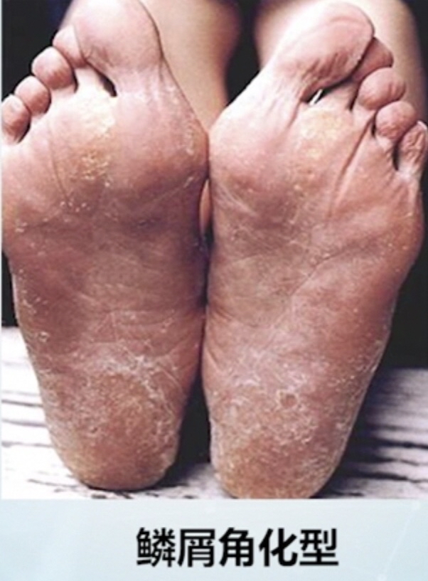 如何治疗脚气香港脚,脚气为什么叫做香港脚癣