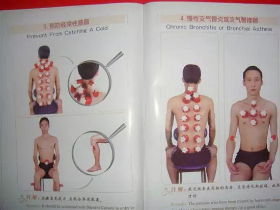 拔罐有哪些穴位图解,最全拔罐穴位疗法图解