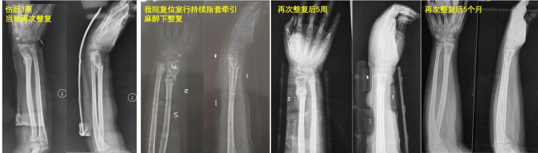 两个儿童前臂骨折争议病例之——元芳你怎么看