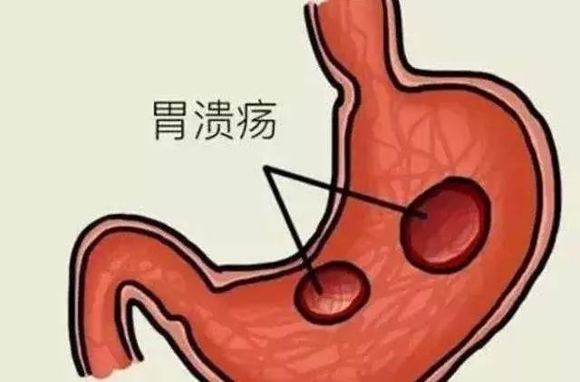胃溃疡十二指肠溃疡一直吐一直痛,胃溃疡和十二指肠溃疡饭前饭后疼