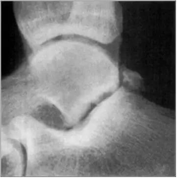 踝关节撞击症问诊,踝关节内侧撞击综合症位置图