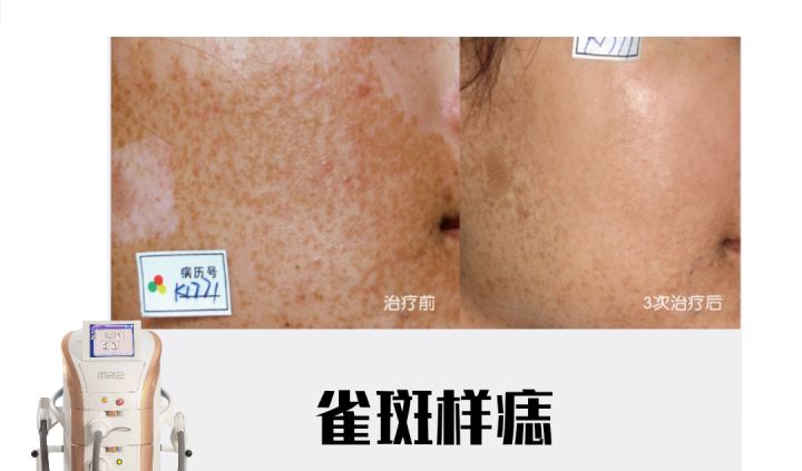 哪种医美项目祛痘印最有效,最有效的医美抗衰项目