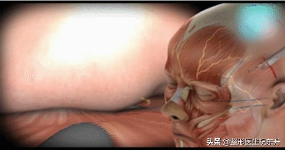 内窥镜除皱术术前术后对比,内窥镜除皱术