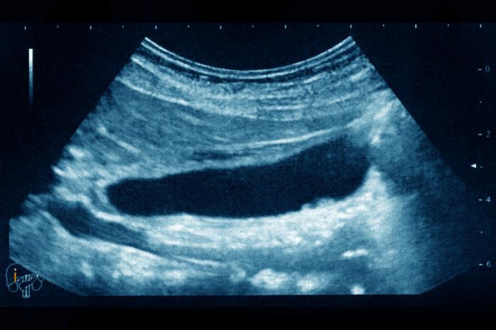 烧心如何判断是胃酸还是胆汁,反酸烧心一定是反流胆汁吗