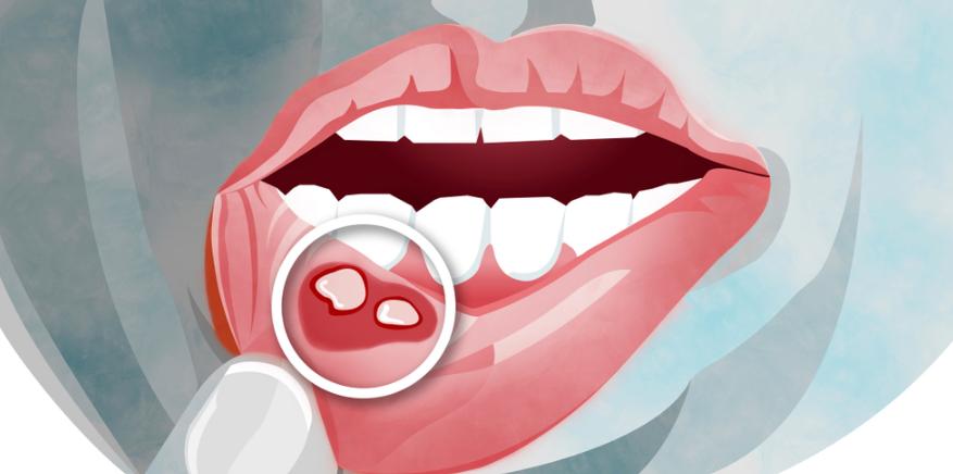 把维生素b涂在溃疡上,维生素c可以撒在舌头溃疡上吗