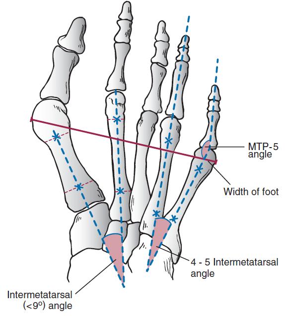 小脚趾拇囊炎的治疗方法,小脚趾侧边肿痛用什么药