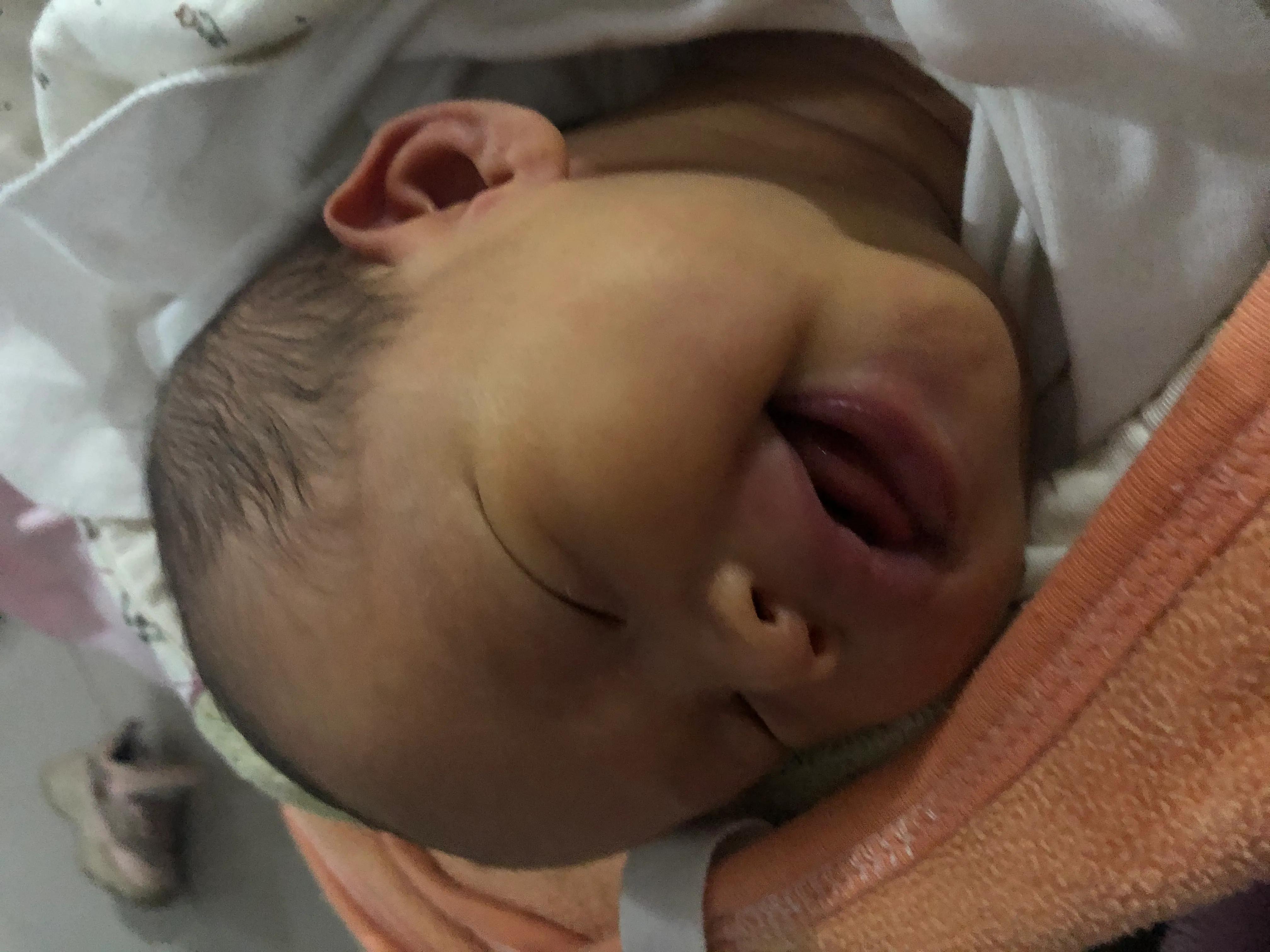 20天的宝宝黄疸高眼球黄,新生儿20天黄疸不退眼睛周围还黄