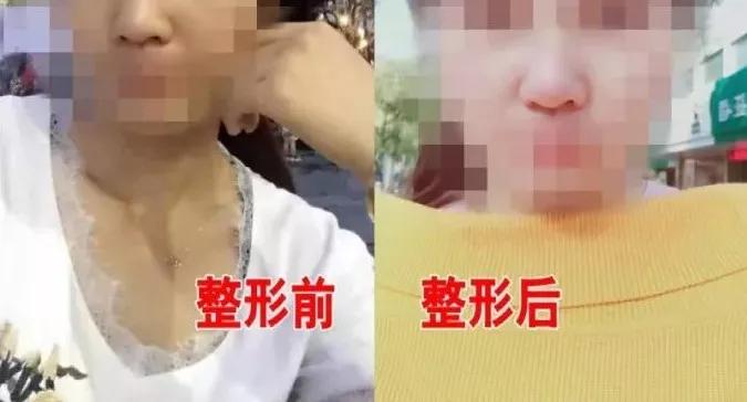美容院整容鼻子歪,整形医院鼻子做歪了怎么办