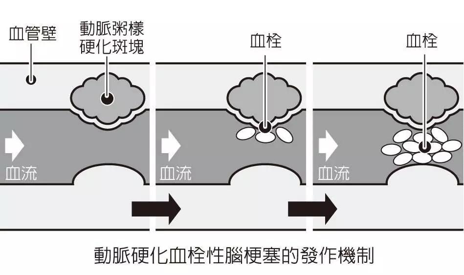 脑梗塞偏瘫康复去哪里做好,脑梗偏瘫康复最好的治疗方法