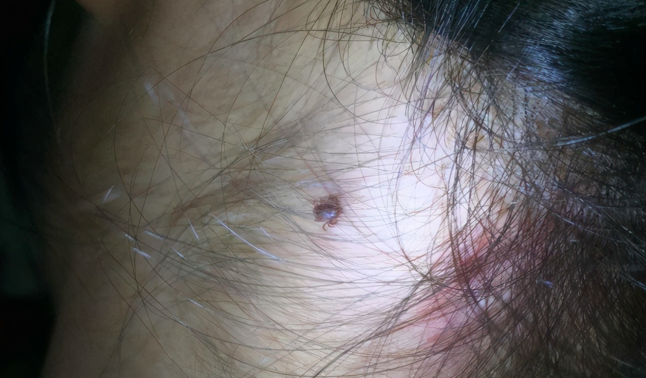 小朋友被蜱虫咬了怎么办,小孩遭蜱虫咬爸爸抱小孩进医院