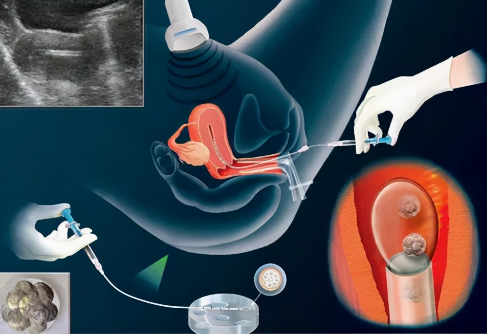 为什么备孕几年都不愿意做试管,备孕不成功先通液还是先造影