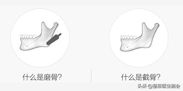 脸型侧边扁平怎么改善,方脸下颌骨宽大怎么改善