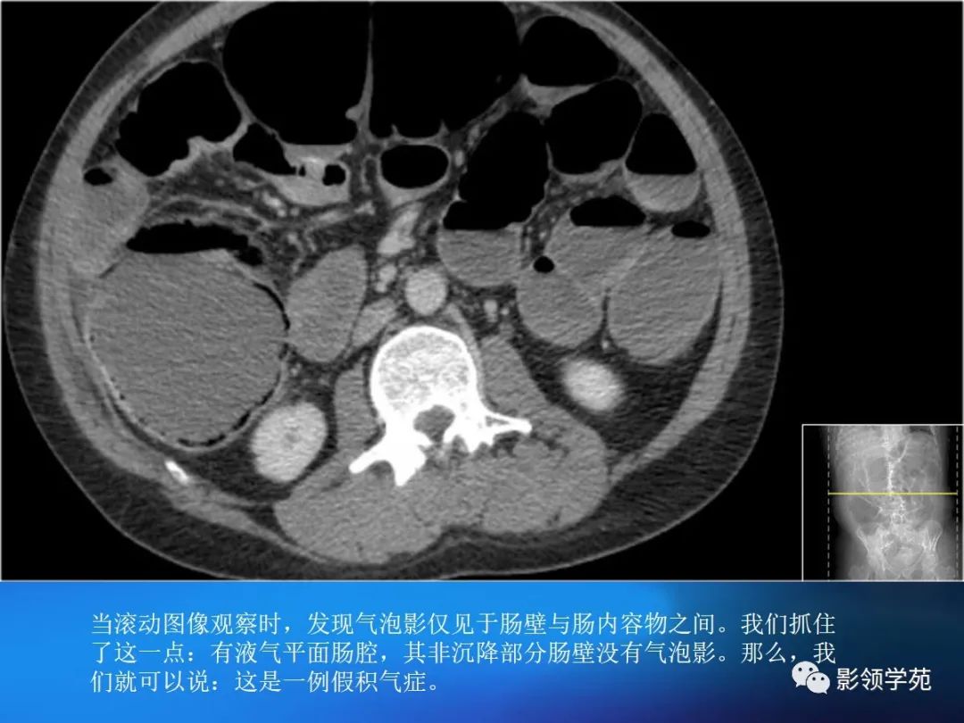 肠道内壁增厚,肠道扩张ct表现