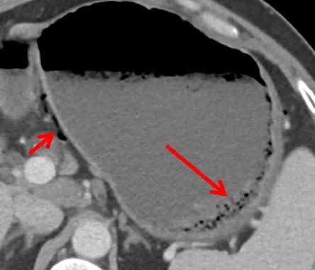 腹部ct能看出来胃的毛病吗,如果胃有问题腹部ct看得出来吗