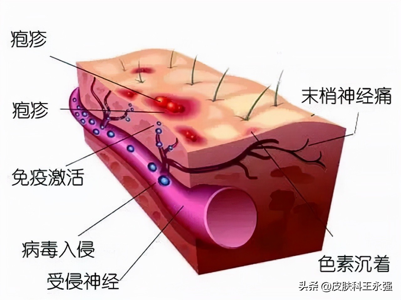 得了带状疱疹可能是什么病的征兆,警惕带状疱疹72小时内必须处理