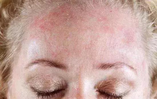 再昂贵的护肤品，也解决不了你的“敏感肌”？