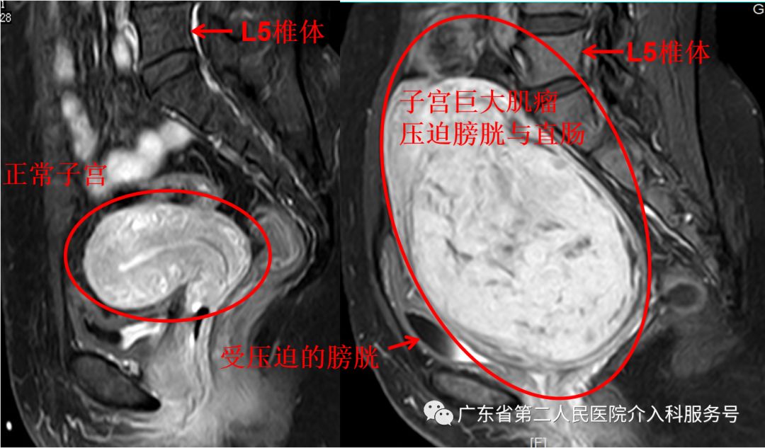 子宫肌瘤引起“大姨妈”排山倒海,淋沥不净……针眼妙方解除烦恼