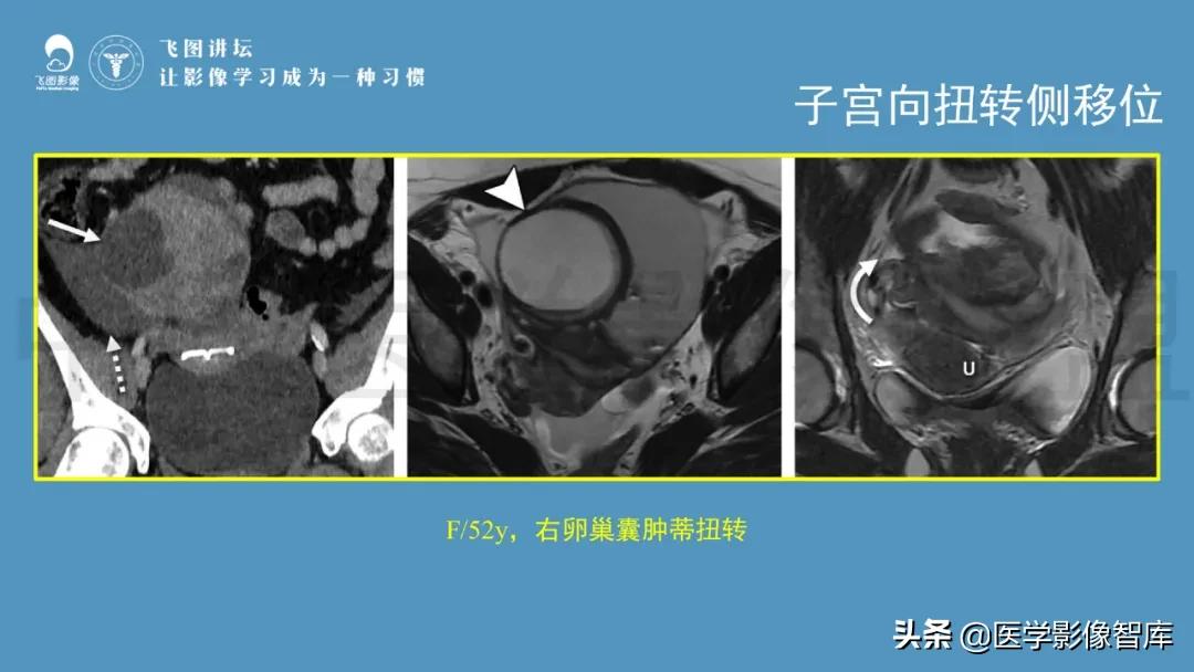 子宫解剖结构输卵管和卵巢位置,子宫附件ct影像学正常解剖表现