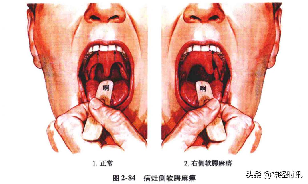 脑干解剖,脑干神经解剖